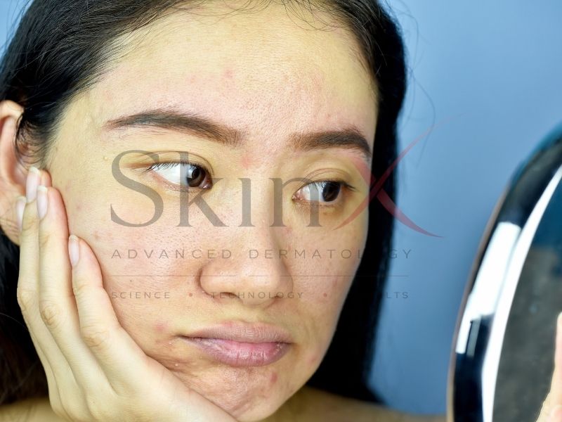 Da sau laser hoặc bị khô sạm cần 1 giải pháp phục hồi chuyên sâu 